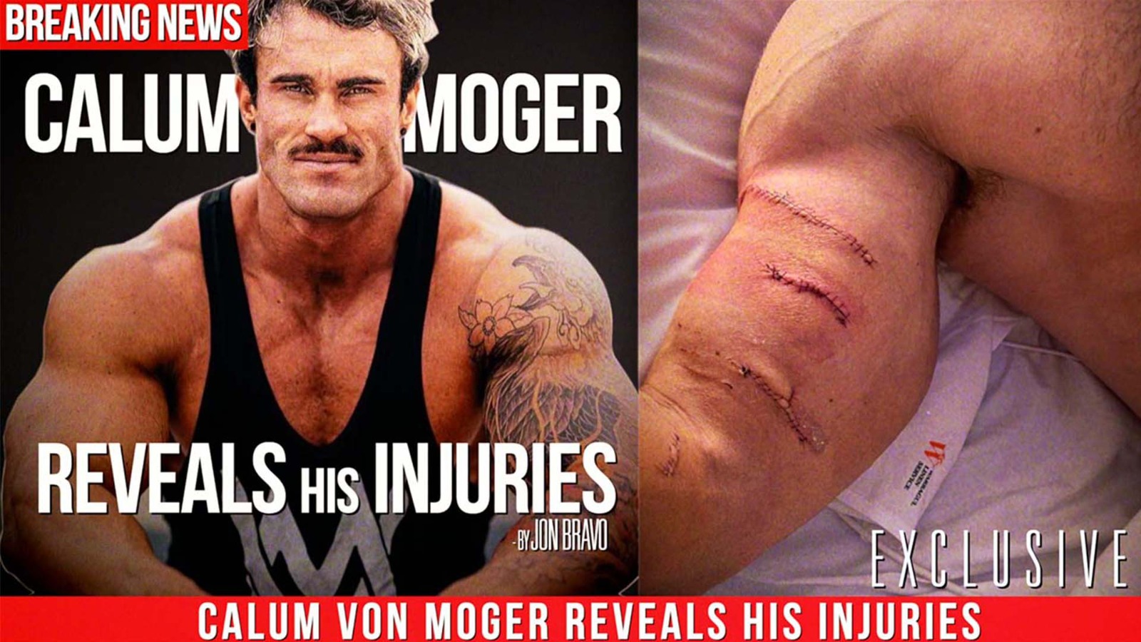 Calum Von Moger Finally Reveals His Injuries! Calum Von Moger Finally Reveals His Injuries!