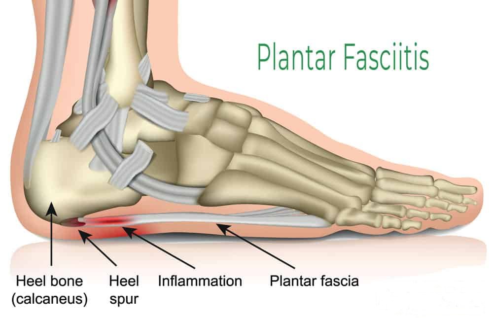 Plantar Fasciitis Treatments for an Active Lifestyle Plantar Fasciitis Treatments for an Active Lifestyle