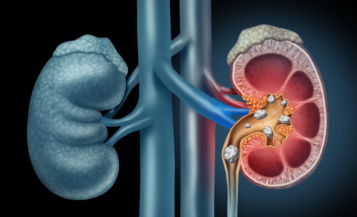 What Are Kidney Stones and How Can You Avoid Them? What Are Kidney Stones and How Can You Avoid Them?